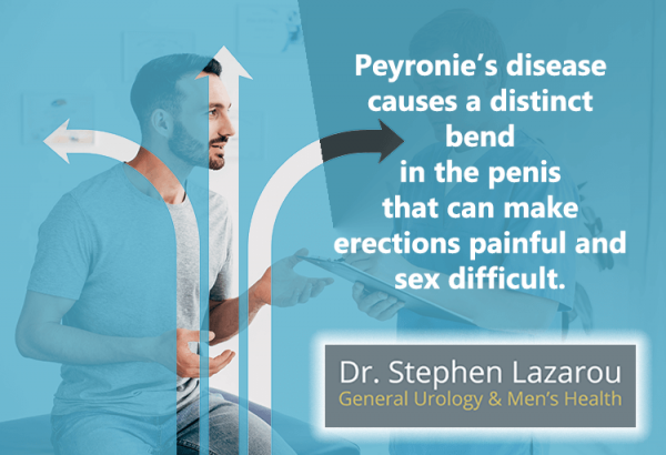 Peyronie's disease causes a distinct bend in the penis that can make erections painful and sex difficult.